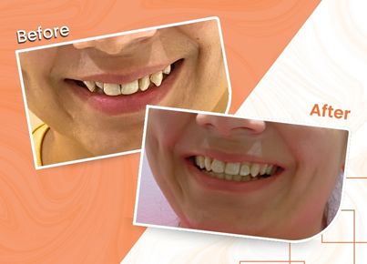 Smile correction