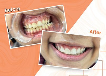 Teeth whitening